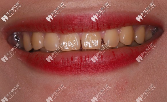 做牙齒美白前的一口大黃牙