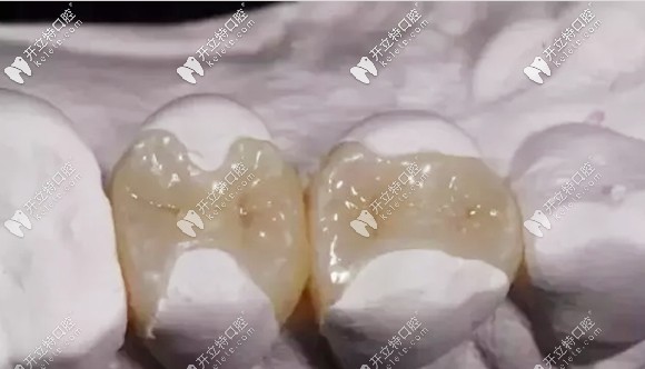 楊哲醫(yī)生對(duì)瓷嵌體修復(fù)的介紹