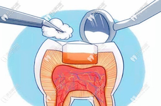 魏文龍醫(yī)生簡介樹脂和嵌體補牙的區(qū)別