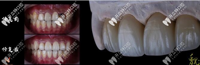 威蘭德全瓷牙前后對(duì)比