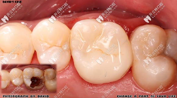 做完E-max鑄瓷嵌體修復(fù)后的效果圖