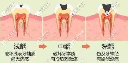 齲齒的發(fā)展過程