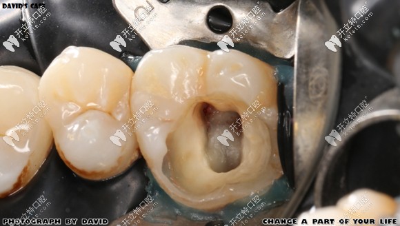 齲壞牙體去腐后的樣子