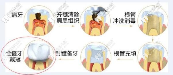 根管治療過程圖示