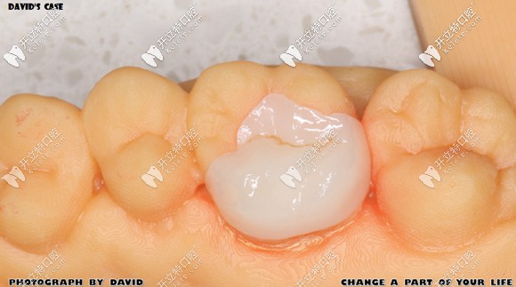 做好的e-max鑄瓷嵌體效果圖