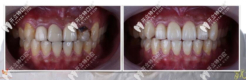 ?？谖⑿谇豢敬裳罁Q全瓷牙真人案例