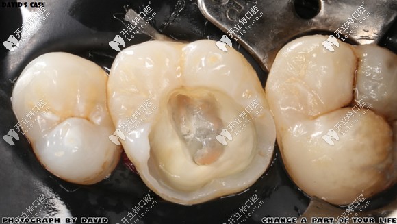 重度齲齒做根管治療后的即刻照
