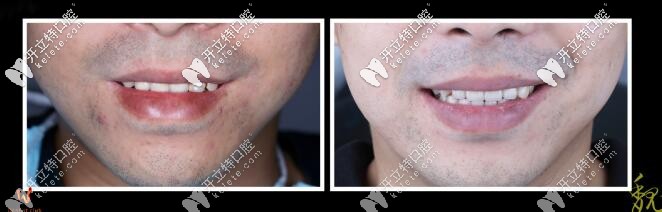 ?？谖⑿ρ揽仆m德全瓷牙真人案例