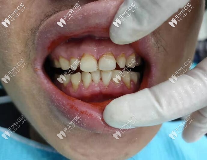 海南?？谖⑿谇粺煗n牙洗牙真人案 