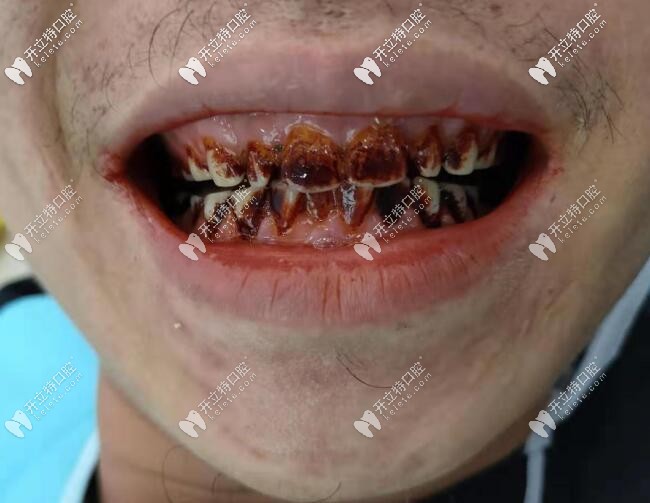 超聲波+噴砂潔牙快速清除煙漬牙,這美白效果無(wú)敵了