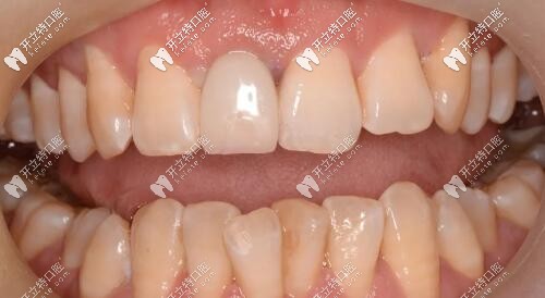 門牙外傷過渡義齒修復(fù)