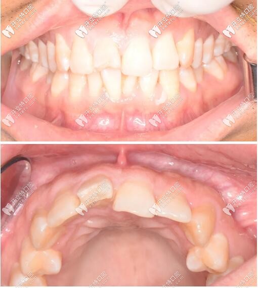 一例門牙外傷松動(dòng)修復(fù)案例