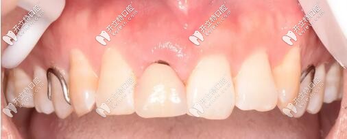 活動(dòng)義齒修復(fù)門牙 