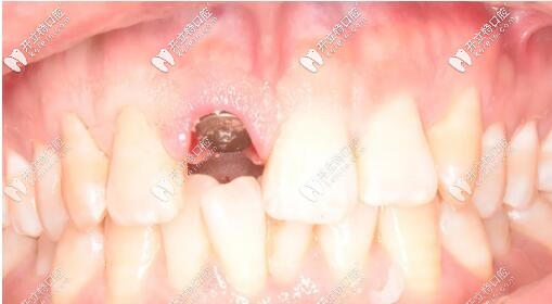 安裝愈合基臺(tái)