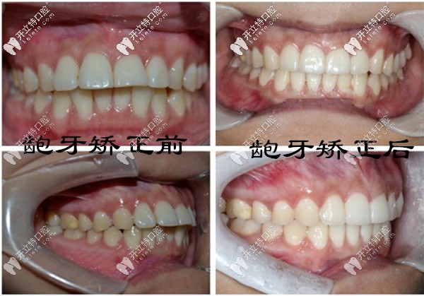 齙牙在?？诙c口腔做矯正前后對比照片