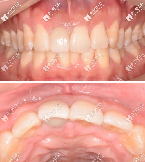 門牙瑞士iti鈦親水4.1mm*10mmBL種植體修復(fù)案例