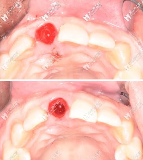 門牙種植牙制備窩洞