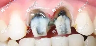 烤瓷牙黑線(xiàn)問(wèn)題