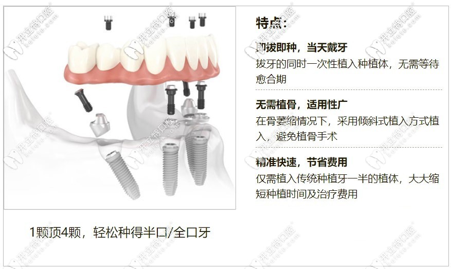 牙管家特色種植技術(shù)當(dāng)日用種植牙體系特點