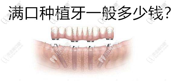 才二十歲就烤瓷了17顆牙,想換滿口牙種植一般多少錢？