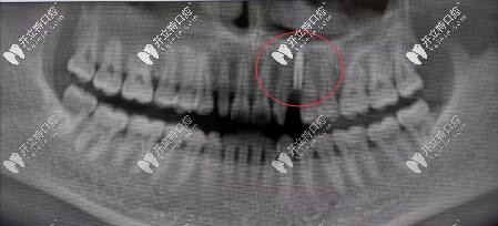 案例:法國安卓健Axiom?2.8mm型號(hào)種植體修復(fù)缺失切牙虎牙超贊