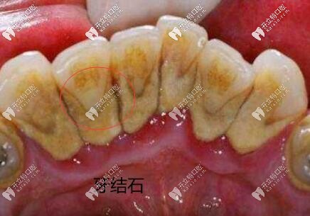 潔牙98起,國產(chǎn)全瓷牙888起,安康私人連鎖口腔收費(fèi)價格表盤點(diǎn)