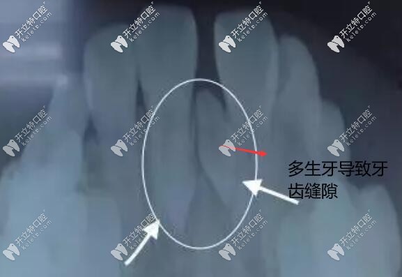 多生牙導致牙縫