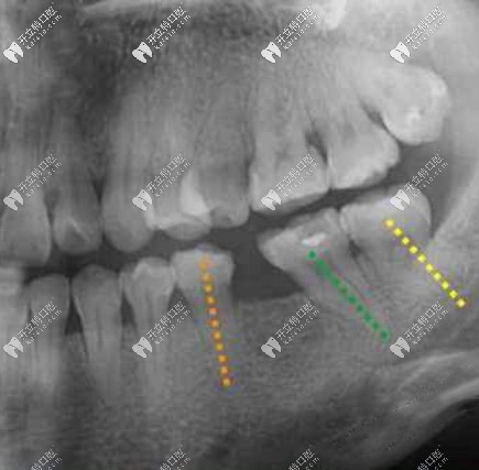 20多歲第一磨牙掉了沒選價(jià)格便宜的登騰用了ankylos植體種牙