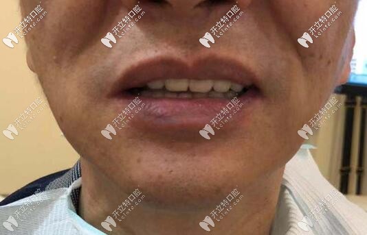 老爸在福州維樂(lè)口腔做全口種植牙后的照片