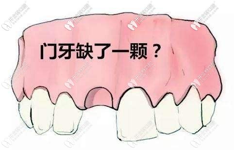 門牙缺了一顆牙