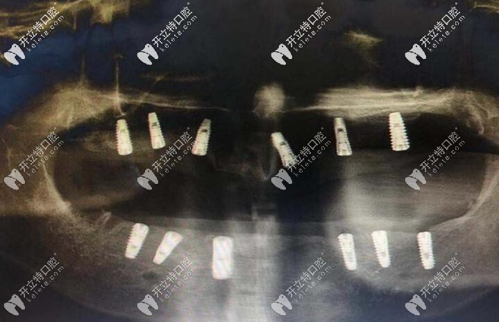 老爸做全口種植牙后的CT片