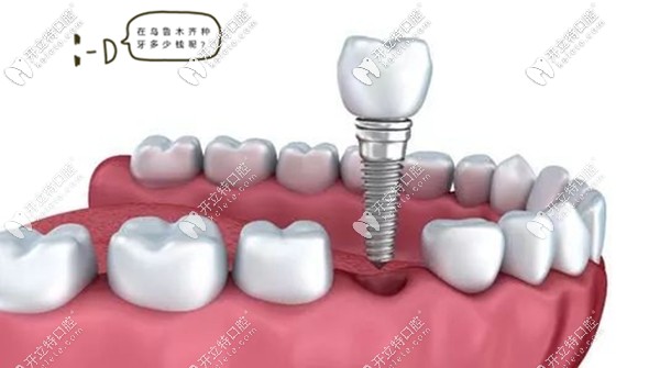 烏魯木齊牙科資訊:做種植牙只關(guān)注價(jià)格是誤區(qū),這點(diǎn)更重要...