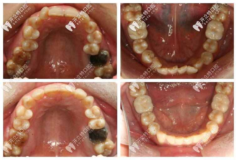 深覆合矯正前后的口內(nèi)照 深覆合矯正前后的口內(nèi)照