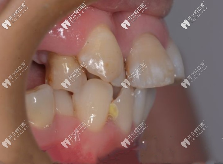 從側(cè)面看大門牙突出很明顯