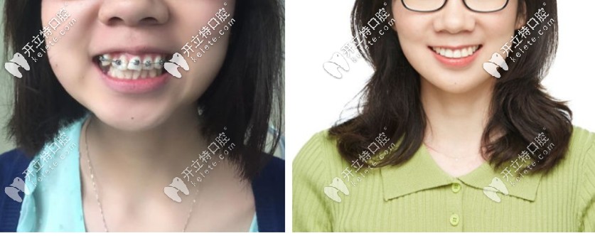 爆我箍牙前后臉型對(duì)比照?qǐng)D，你還覺得門牙外凸沒必要矯正