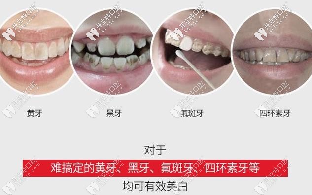  英國Wyman美白適用牙齒情況