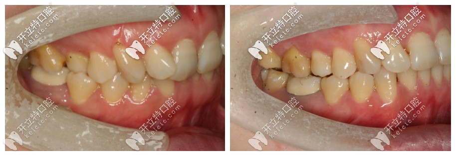 從側(cè)面照更能看出來(lái)牙齒原本的問(wèn)題 從側(cè)面照更能看出來(lái)牙齒原本的問(wèn)題