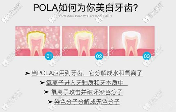 澳洲 SDI POLA 美白牙齒過程