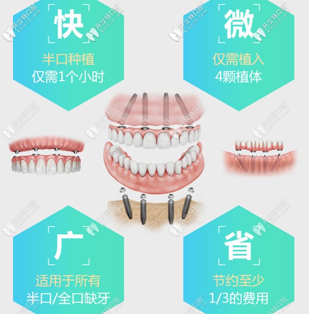 all-on-4全口種植技術(shù)