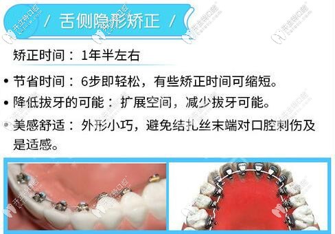 舌側(cè)隱形矯正優(yōu)勢