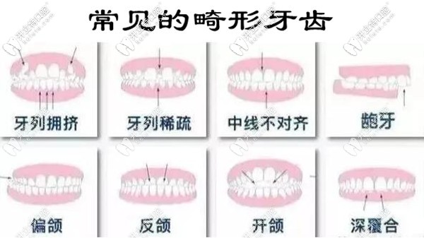 常見的畸形牙齒