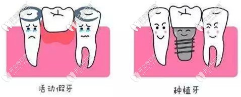 活動假牙與種植牙的區(qū)別