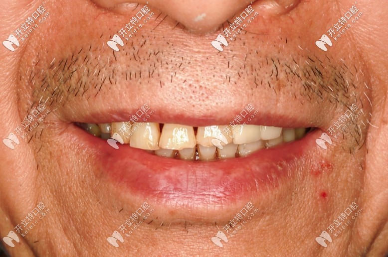 全口種植牙1年效果圖