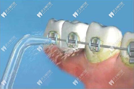 牙周病正畸