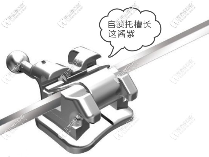 自鎖托槽矯正一萬(wàn)貴嗎