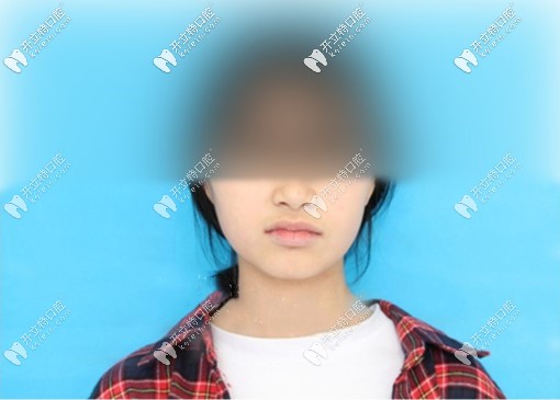 拔4顆牙臉型圖，我覺得自己臉沒塌