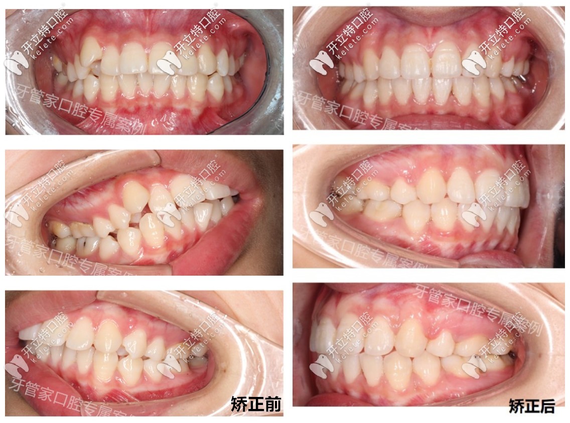骨性齙牙戴牙套矯正前后效果對(duì)比圖