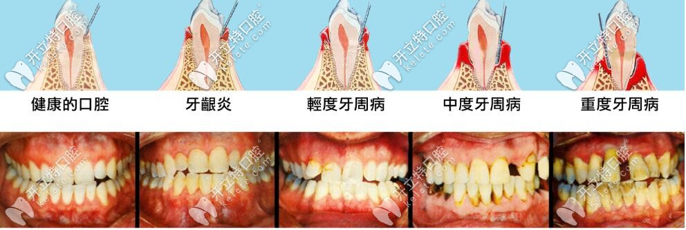 牙周病發(fā)展過程