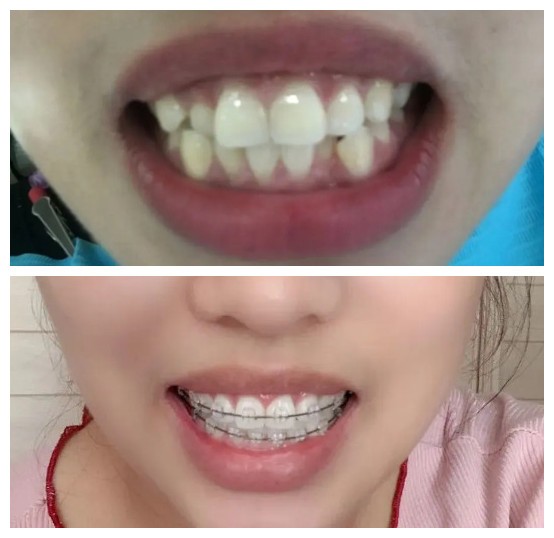 做Tomy陶瓷托槽半隱形矯正牙列不齊，花了我一萬八大洋貴嗎