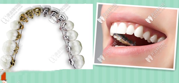 關(guān)于舌側(cè)矯正的價格貴于唇側(cè)矯正的原因